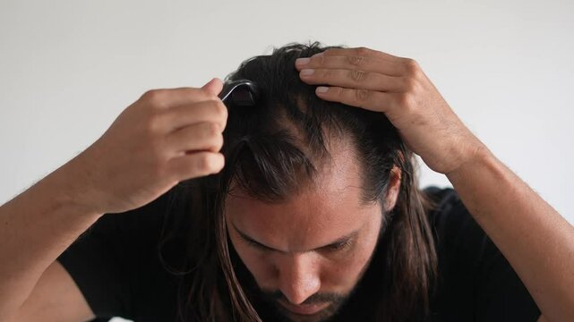man using roller hair on his scalp to prevent baldness, Hair shedding