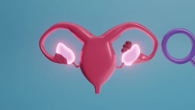 World Ovarian Cancer Day concept. Female reproductive health design element. PCOS, Symbolizes cancer awareness. Female reproductive system. Gynecological, Uterine cancer, Panic disorder. 3d animation
