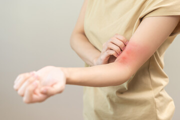 Dermatology asian young woman, girl allergy, allergic reaction from atopic, insect bites on her...