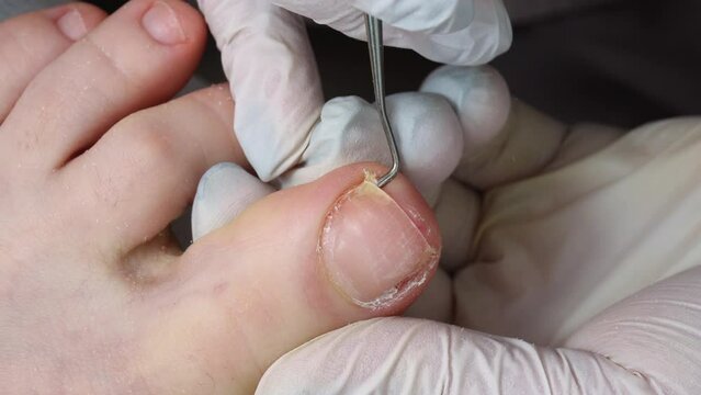 Podologist uses a curette to remove a callus on the toe