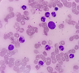 Bone marrow study (BMS).Panmyelosis. Myeloproliferative disorder. Acute myeloid leukemia.