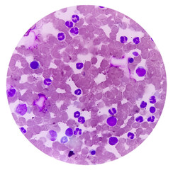 Bone marrow study (BMS).Panmyelosis. Myeloproliferative disorder. Acute myeloid leukemia.