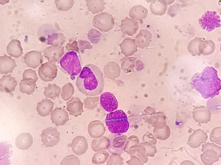 Blood cancer. Photomicrograph of Acute Leukemia, a cancer of white blood cell. Bone marrow
