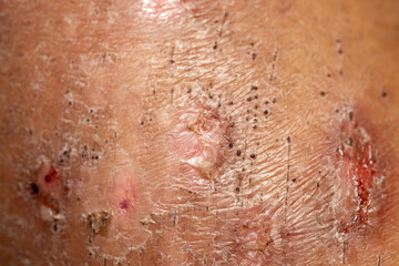Fototapeta premium Background image of wounds caused by Systemic Lupus erythematosus (SLE) or Lupus.