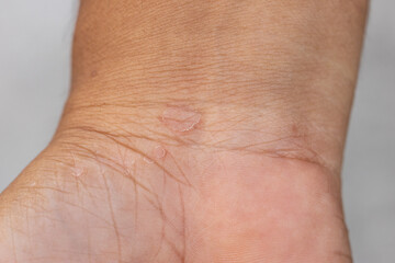 Background image of wounds caused by Systemic Lupus erythematosus (SLE) or Lupus.