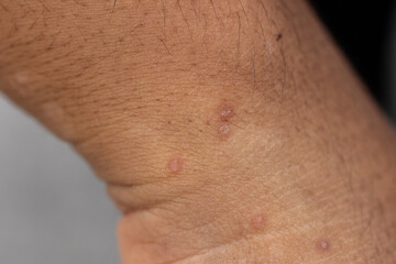 Background image of wounds caused by Systemic Lupus erythematosus (SLE) or Lupus.
