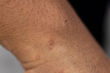 Background image of wounds caused by Systemic Lupus erythematosus (SLE) or Lupus.