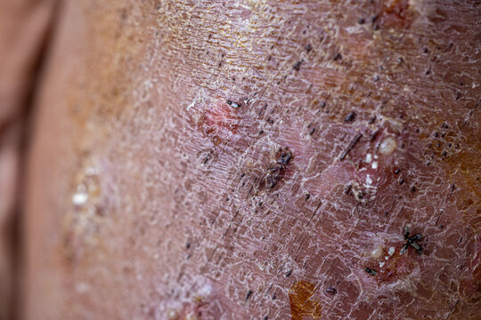 Background image of wounds caused by Systemic Lupus erythematosus (SLE) or Lupus.