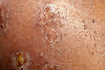 Fototapeta premium Background image of wounds caused by Systemic Lupus erythematosus (SLE) or Lupus.
