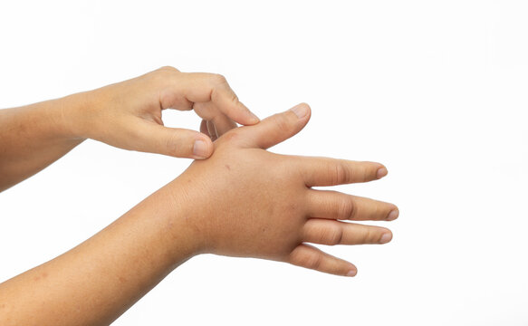 Swollen hand from allergic of insect stings. Skin allergic care.