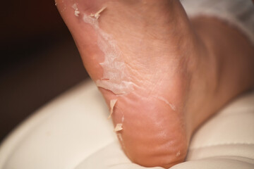 Woman patient showing peeling skin on feet after beauty treatment