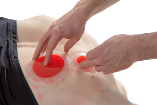 Close-up of person receiving cupping therapy with transparent cups and red stains on the back, focusing on alternative medical treatment.