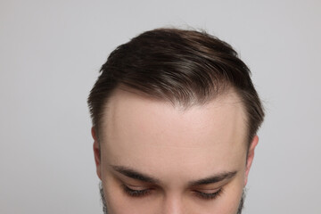 Baldness concept. Man with receding hairline on light grey background, closeup