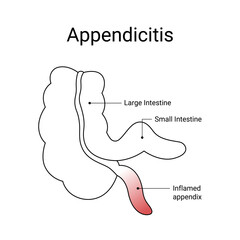 Appendicitis disease medical design with line style