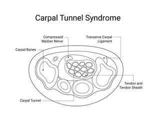 Diagram of carpal tunnel syndrome medical design with line style