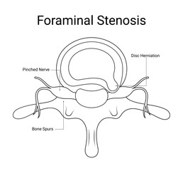Diagram of foraminal stenosis medical design in line style