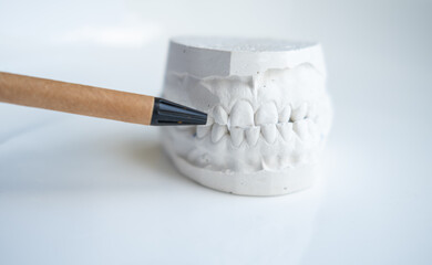 White plaster impression of the dental jaw of a patient with crooked teeth and malocclusion....