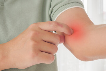 Young asian man itching and scratching on arm from itchy dry skin eczema dermatitis