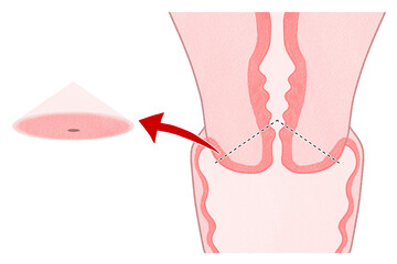 Blank Cervical conization (Cone biopsy) unlabeled diagram PNG