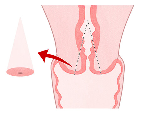 Blank Cervical conization (Cone biopsy) unlabeled diagram PNG