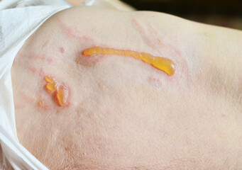 Decubitus ulcer. Pressure ulcers on skin tissue. The increased pressure prevents the blood from...