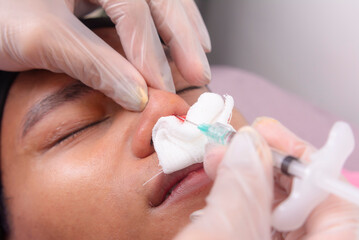 Example of Nonsurgical rhinoplasty or nose dermal filler procedure on the tip of the nose of a male patient. injecting a filler ingredient, such as hyaluronic acid