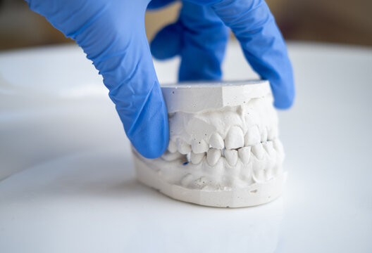 White plaster impression of the dental jaw of a patient with crooked teeth and malocclusion. Manufacturing of dentures and crowns based on orthodontic impressions