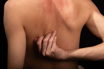 Young man, shirtless, scratching his back with his hands. Skin disease. Irritation, allergy.