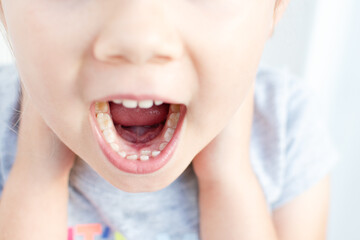 Adult permanent teeth coming in front of the child's baby teeth: shark teeth. Little girl's open mouth.