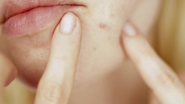 Problems face skin with acne and enlarged pores. Woman touching her face with her hands trying to squeeze a pimple	

