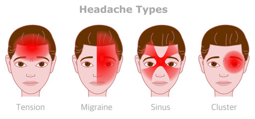 Head, face pains. Headache types. Cluster, sinus, tension, migraine. Different treatment. Sick female cartoon face. Woman face gradient red location, area. Vector illustration