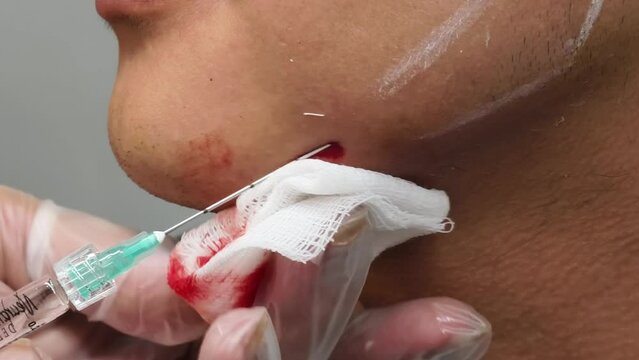 Jawline filler procedure for male patient. Injecting filler gel or hyaluronic acid for a more square jaw look. Done at a esthetic clinic.