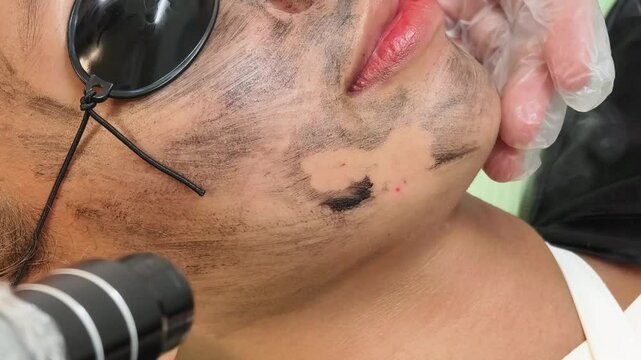 A young asian lady undergoes a laser carbon peel procedure at a skin or dermatologist clinic. Also known as pico laser facial.