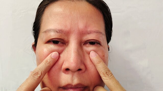Portrait the wrinkle and Flabby skin, swelling and ptosis beside the eyelid, dark spots and blemish, freckles and scar on the face of middle aged woman, health care and beauty concept.