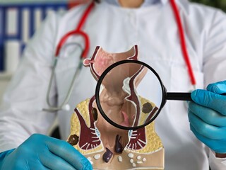 Doctor holds magnifying glass and anatomical model of rectum with hemorrhoids