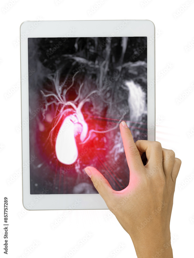 Poster the hand gestures towards a tablet displaying the detailed magnetic resonance cholangiopancreatograp