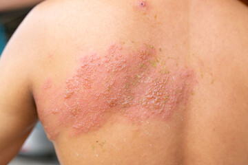 Fototapeta premium Shingles occurs on the body.Herpes zoster 