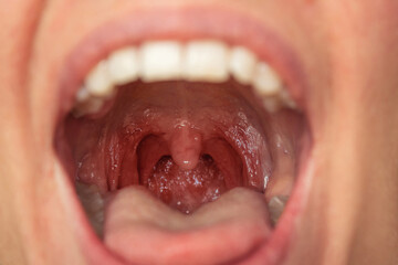 The woman suffers from pharyngitis. Red sore throat caused by infections and viruses, close-up...