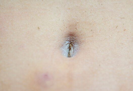Navel. Dirty people who don't take care of cleanliness.