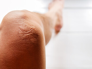 Fototapeta premium Close-up of scars on knee skin imperfections or defects caused by an accident scar healthcare concept