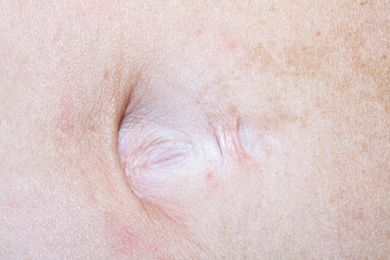 Fototapeta premium Details of the piercing hole above the navel