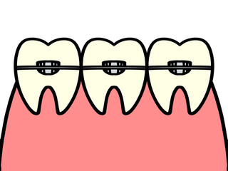 矯正歯科、矯正中の歯のイラスト素材