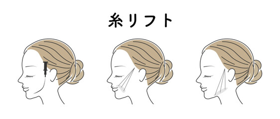 糸リフト_3パターン