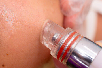 Closeup of Vacuum Suction Facial Treatment. Deep pore cleaning procedure at a beauty clinic. Example of Dermabrasion or Microdermabrasion.