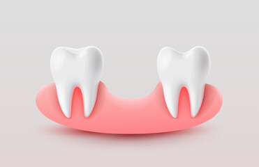 Dental implantation, tooth restoration, symbol on a white background. Vector illustration