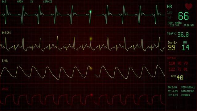 Patient monitor displays vital signs ECG electrocardiogram EKG, oxygen saturation SPO2 and respiration. Medical examination. 4K video footage animation. Cardiac monitoring. Electrocardiography