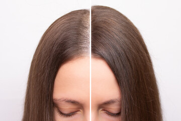 Before and after head shot of a young woman with a receding hairline on her forehead and parting. Baldness. Close-up, front view. Hair care and treatment concept. Hair loss, hair transplant, alopecia
