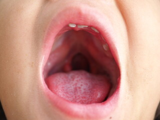 Child girl showing an uvula in a cleft palate. Closeup photo, blurred.