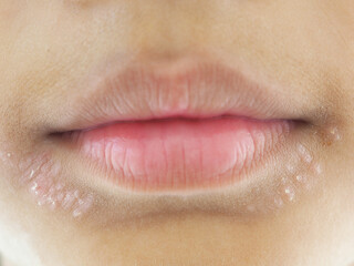 Portrait of a girl with a rash near the mouth, cause is the child's food allergy. Health concept. Closeup photo, blurred.