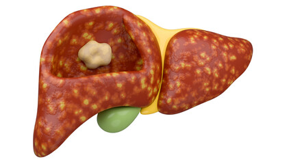 Liver Cancer for diagnosis and treatment